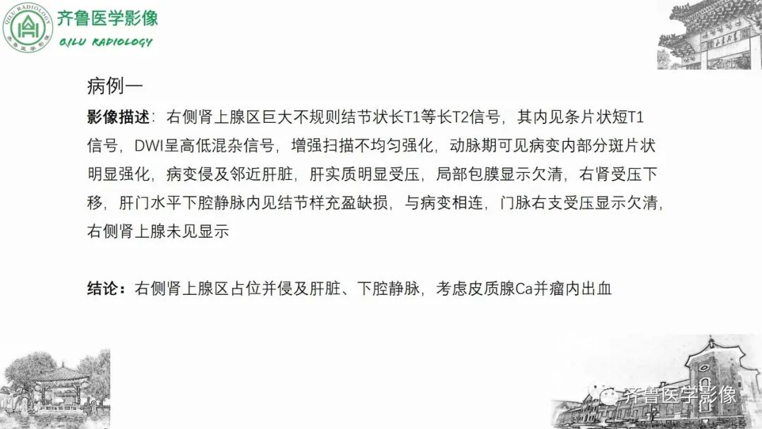 影像PPT - 【病例】肾上腺皮质腺癌2例CT及MR影像-14