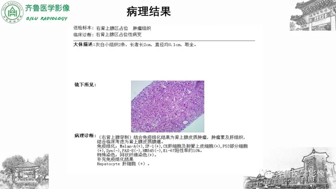 影像PPT - 【病例】肾上腺皮质腺癌2例CT及MR影像-15