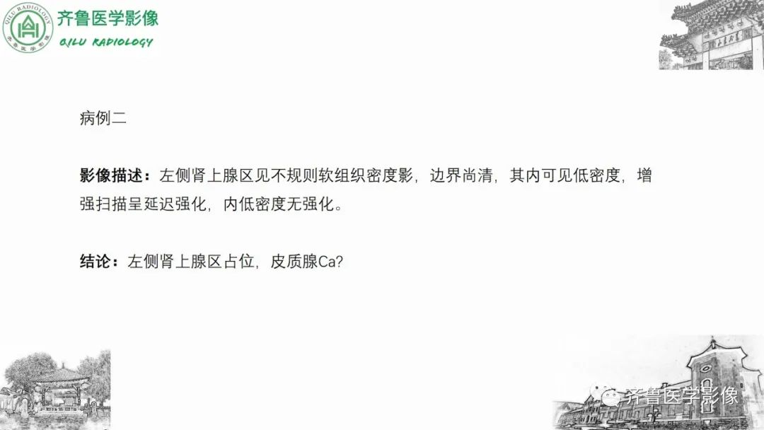 影像PPT - 【病例】肾上腺皮质腺癌2例CT及MR影像-16