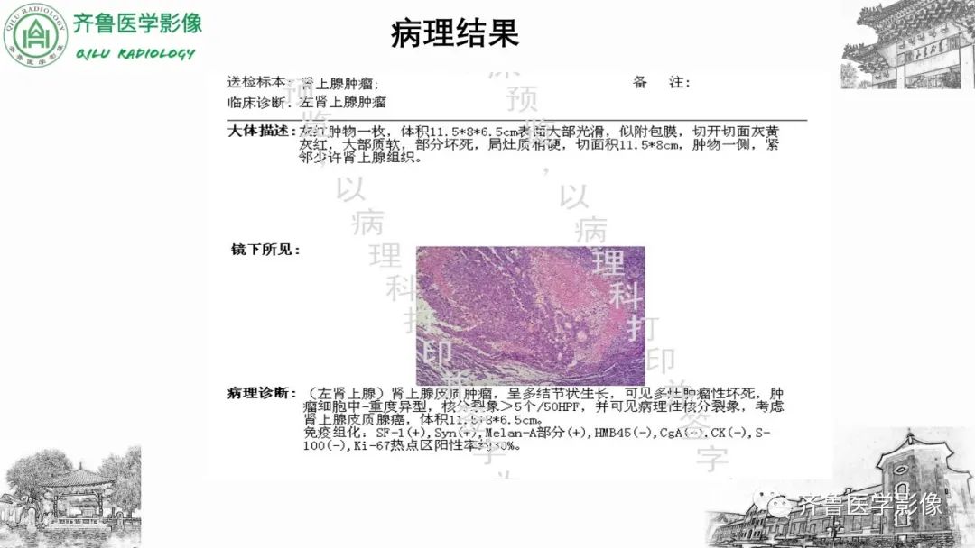 影像PPT - 【病例】肾上腺皮质腺癌2例CT及MR影像-17