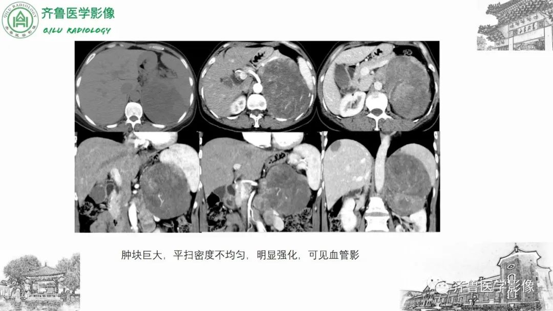 影像PPT - 【病例】肾上腺皮质腺癌2例CT及MR影像-26