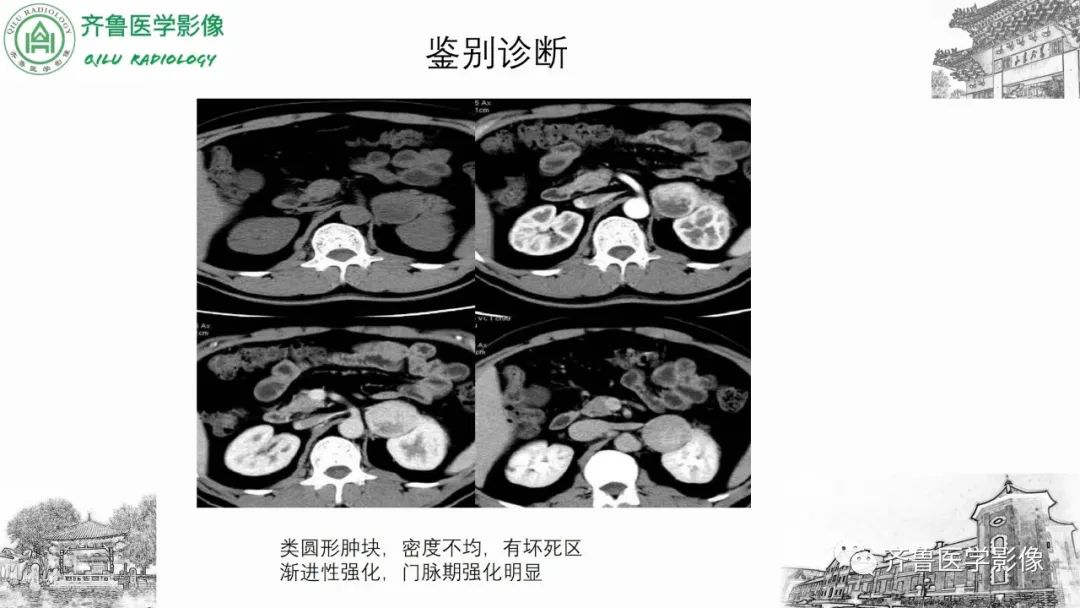 影像PPT - 【病例】肾上腺皮质腺癌2例CT及MR影像-30