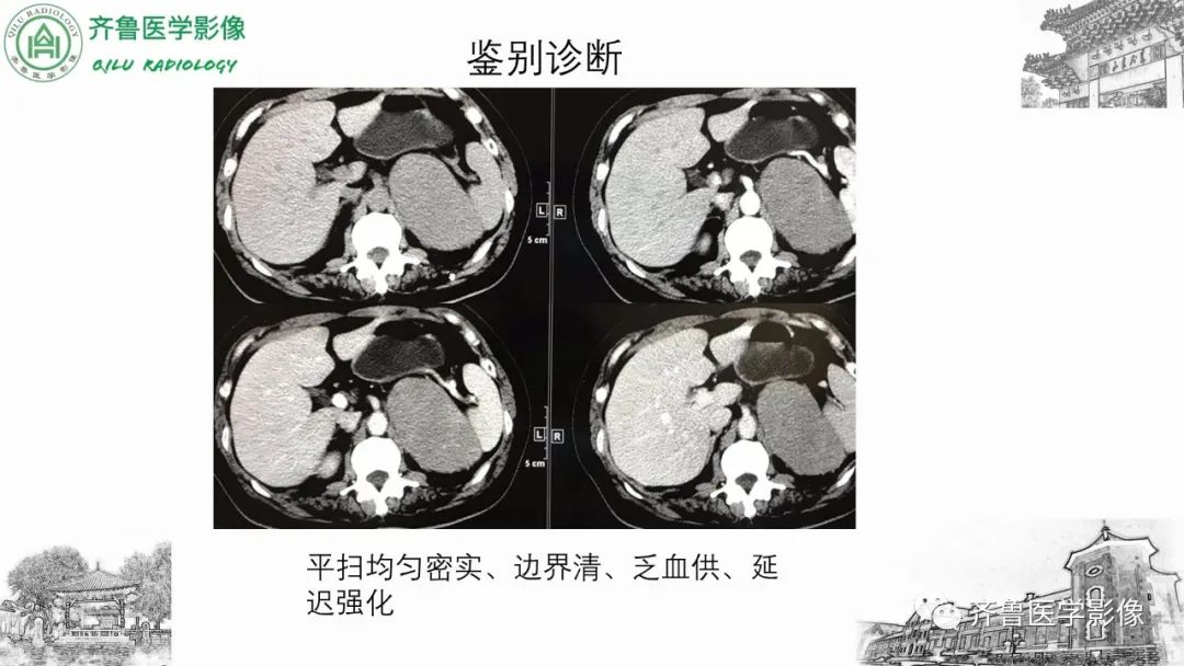 影像PPT - 【病例】肾上腺皮质腺癌2例CT及MR影像-34