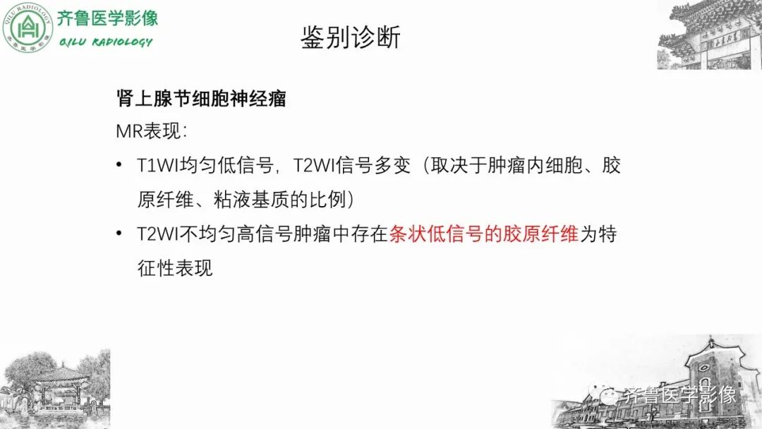 影像PPT - 【病例】肾上腺皮质腺癌2例CT及MR影像-37