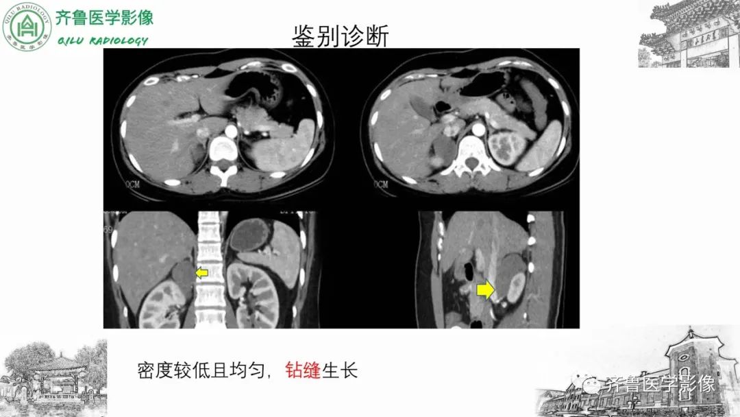 影像PPT - 【病例】肾上腺皮质腺癌2例CT及MR影像-38