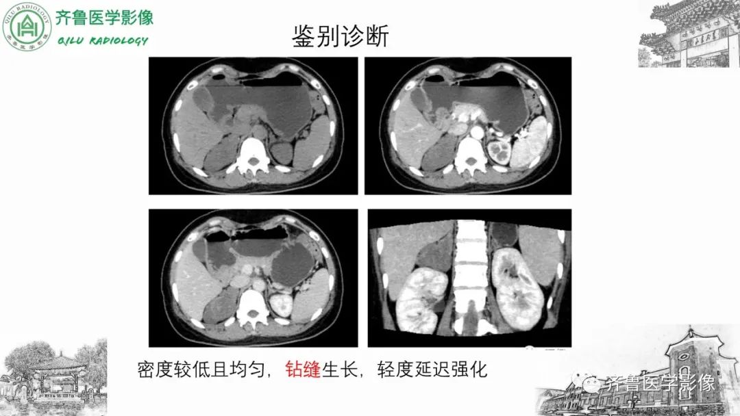 影像PPT - 【病例】肾上腺皮质腺癌2例CT及MR影像-39