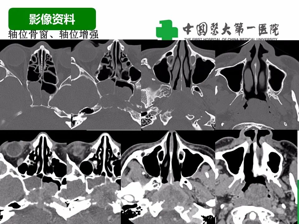 影像PPT - 【病例】鼻咽部肌上皮癌1例CT及MR影像-3