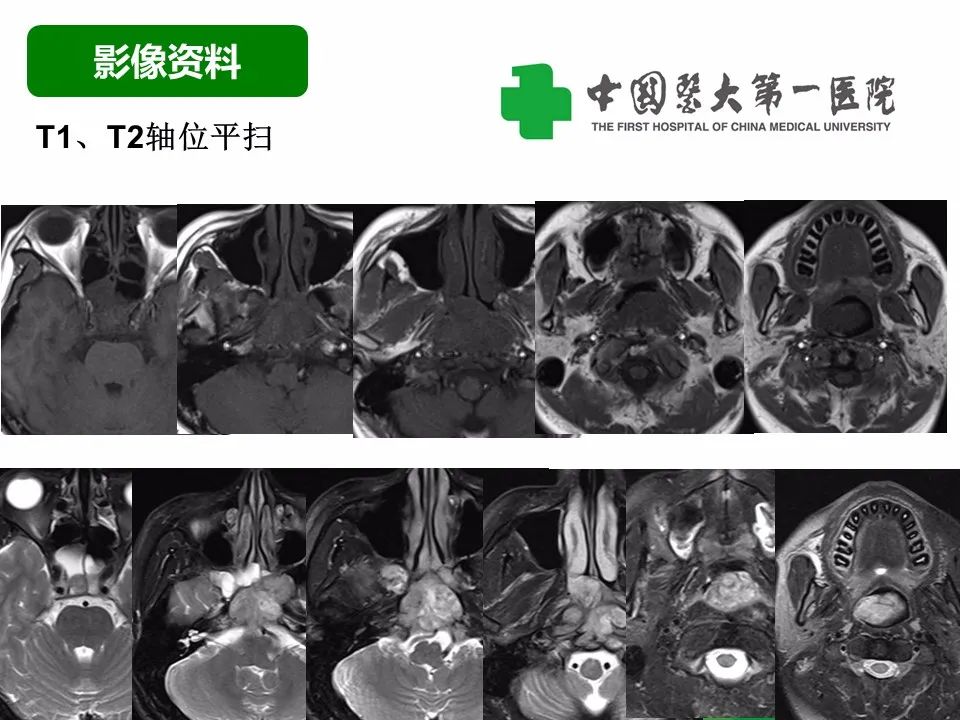 影像PPT - 【病例】鼻咽部肌上皮癌1例CT及MR影像-5