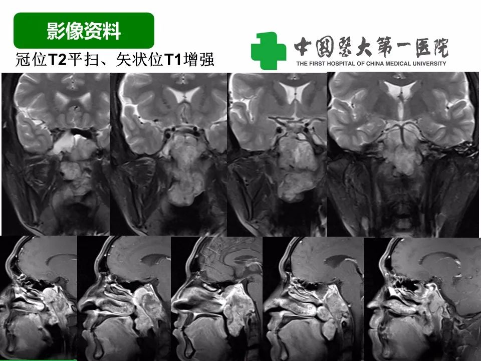 影像PPT - 【病例】鼻咽部肌上皮癌1例CT及MR影像-6