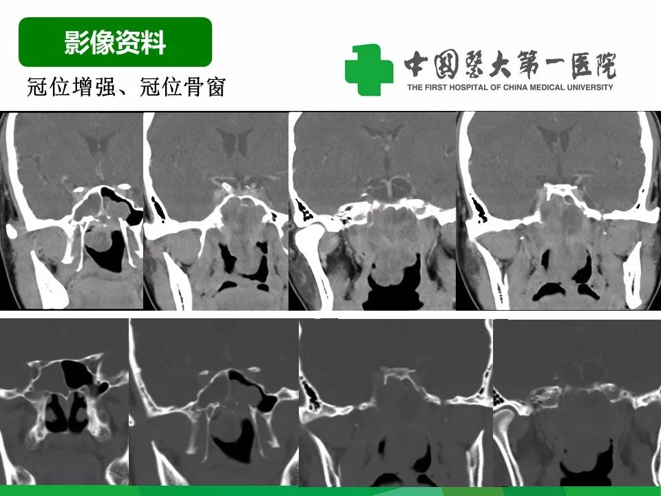 影像PPT - 【病例】鼻咽部肌上皮癌1例CT及MR影像-4
