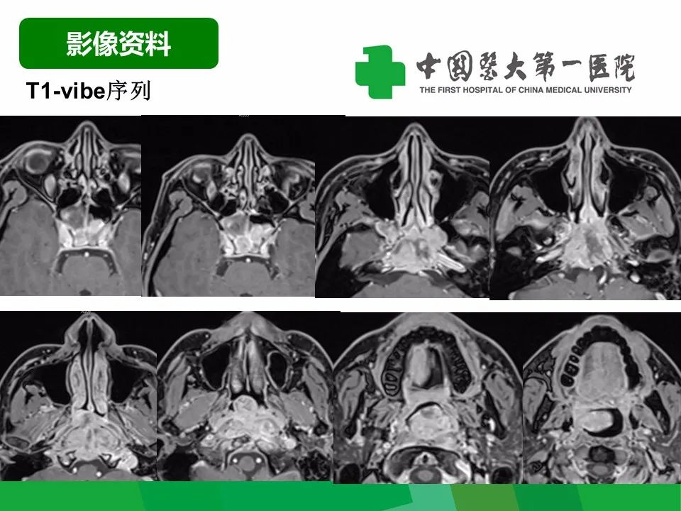 影像PPT - 【病例】鼻咽部肌上皮癌1例CT及MR影像-7