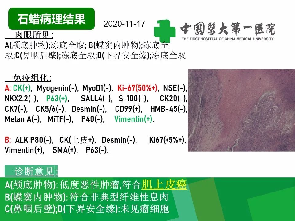 影像PPT - 【病例】鼻咽部肌上皮癌1例CT及MR影像-9