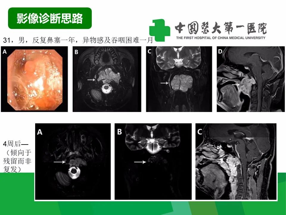 影像PPT - 【病例】鼻咽部肌上皮癌1例CT及MR影像-13