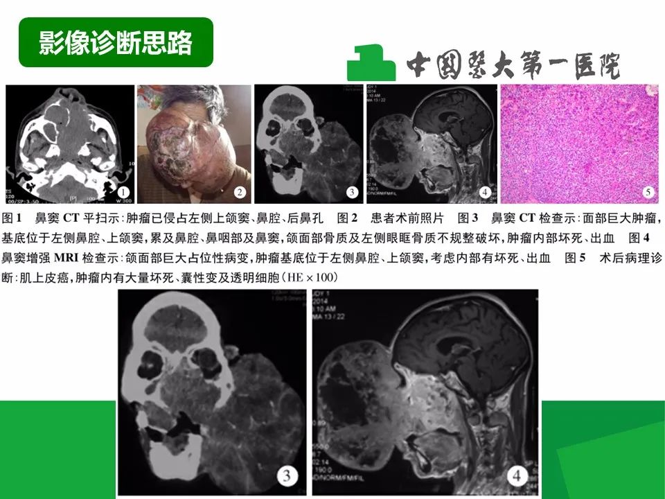 影像PPT - 【病例】鼻咽部肌上皮癌1例CT及MR影像-16