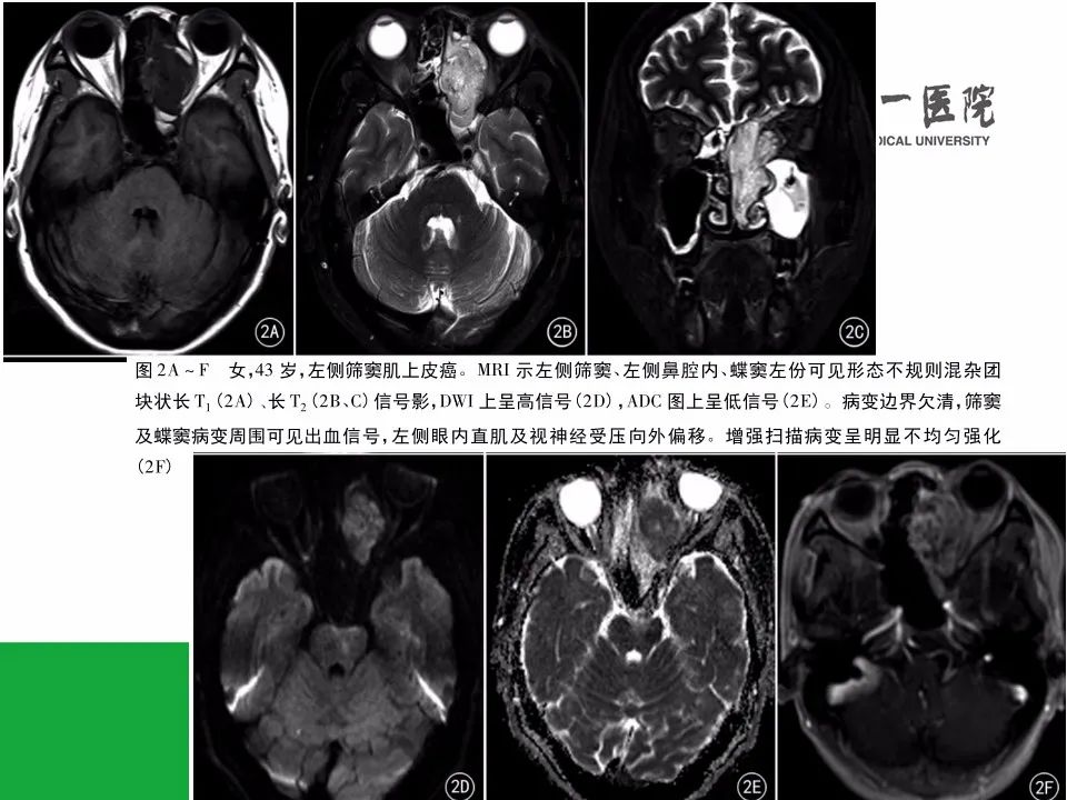 影像PPT - 【病例】鼻咽部肌上皮癌1例CT及MR影像-15