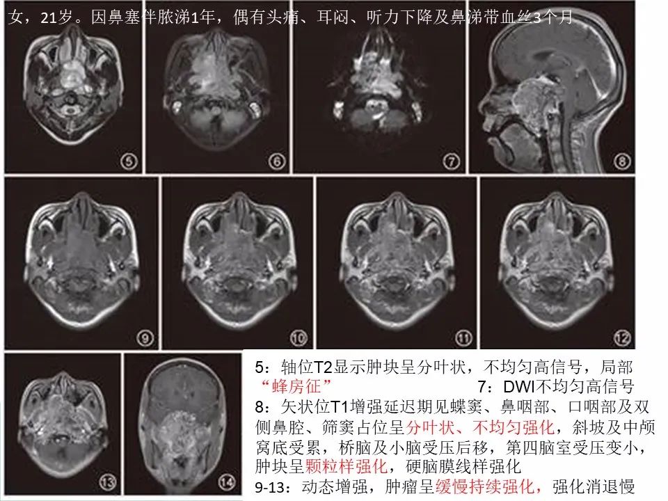 影像PPT - 【病例】鼻咽部肌上皮癌1例CT及MR影像-20