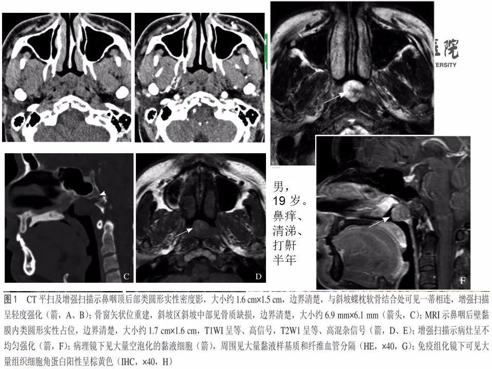 影像PPT - 【病例】鼻咽部肌上皮癌1例CT及MR影像-21