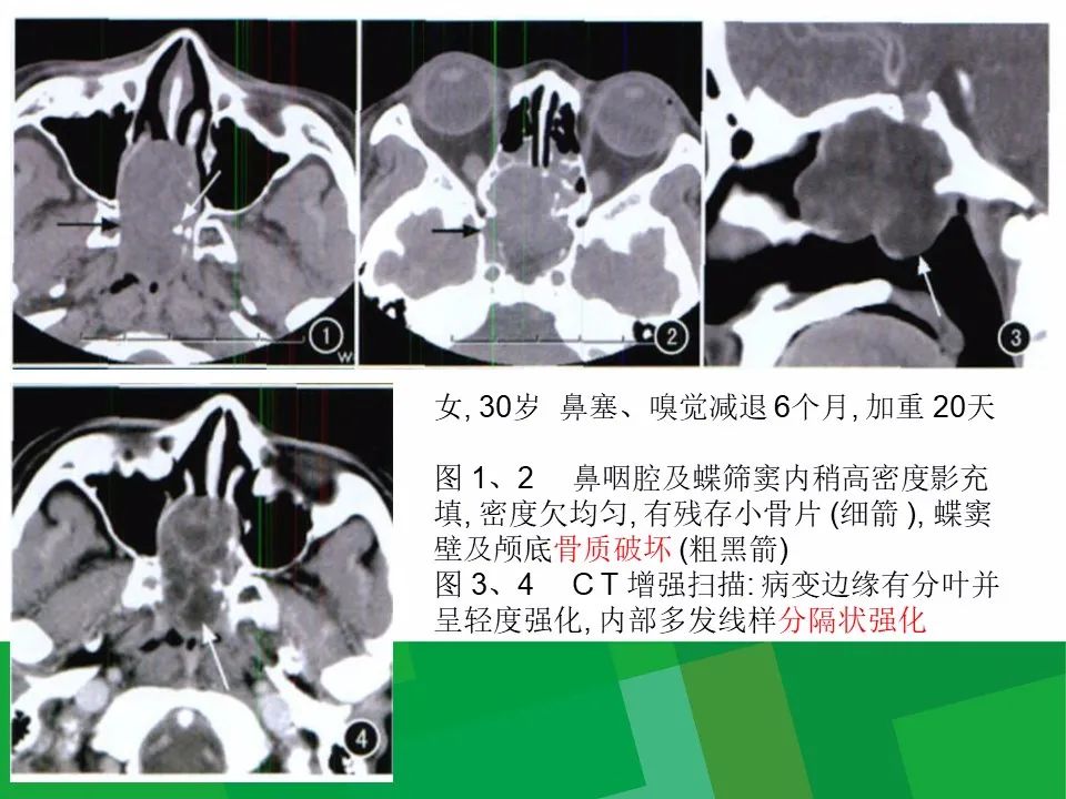 影像PPT - 【病例】鼻咽部肌上皮癌1例CT及MR影像-22