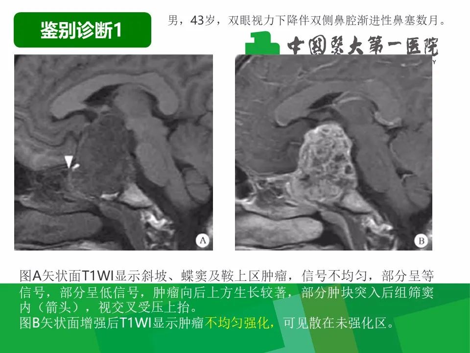 影像PPT - 【病例】鼻咽部肌上皮癌1例CT及MR影像-23