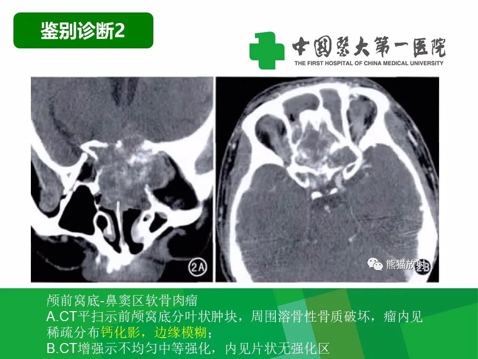 影像PPT - 【病例】鼻咽部肌上皮癌1例CT及MR影像-25