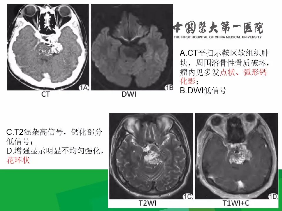 影像PPT - 【病例】鼻咽部肌上皮癌1例CT及MR影像-26