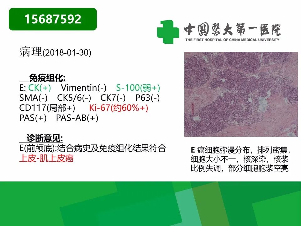 影像PPT - 【病例】鼻咽部肌上皮癌1例CT及MR影像-29