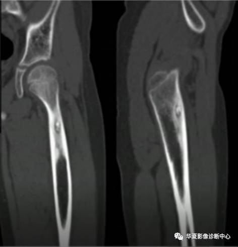 影像PPT - 10个典型病例,让你学会骨肿瘤的诊断思路-2 影像PPT - 10个典型病例,让你学会骨肿瘤的诊断思路-2
