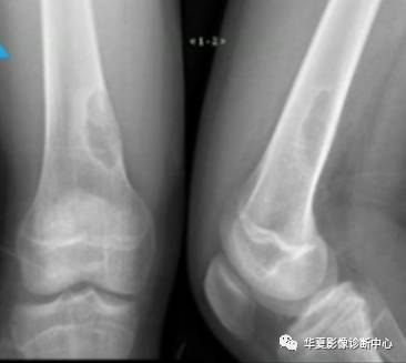 影像PPT - 10个典型病例,让你学会骨肿瘤的诊断思路-8 影像PPT - 10个典型病例,让你学会骨肿瘤的诊断思路-8