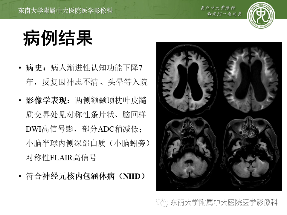 影像PPT - 【PPT】神经元核内包涵体病（NIID）的影像学诊断-2