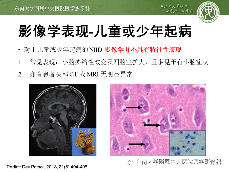 影像PPT - 【PPT】神经元核内包涵体病（NIID）的影像学诊断-15