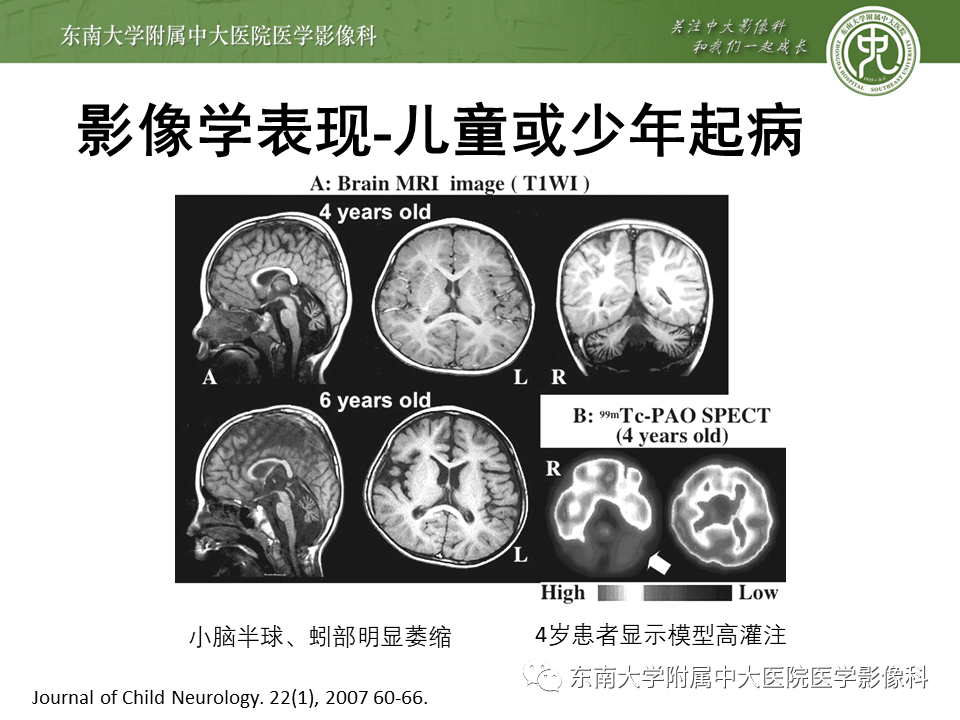 影像PPT - 【PPT】神经元核内包涵体病（NIID）的影像学诊断-16