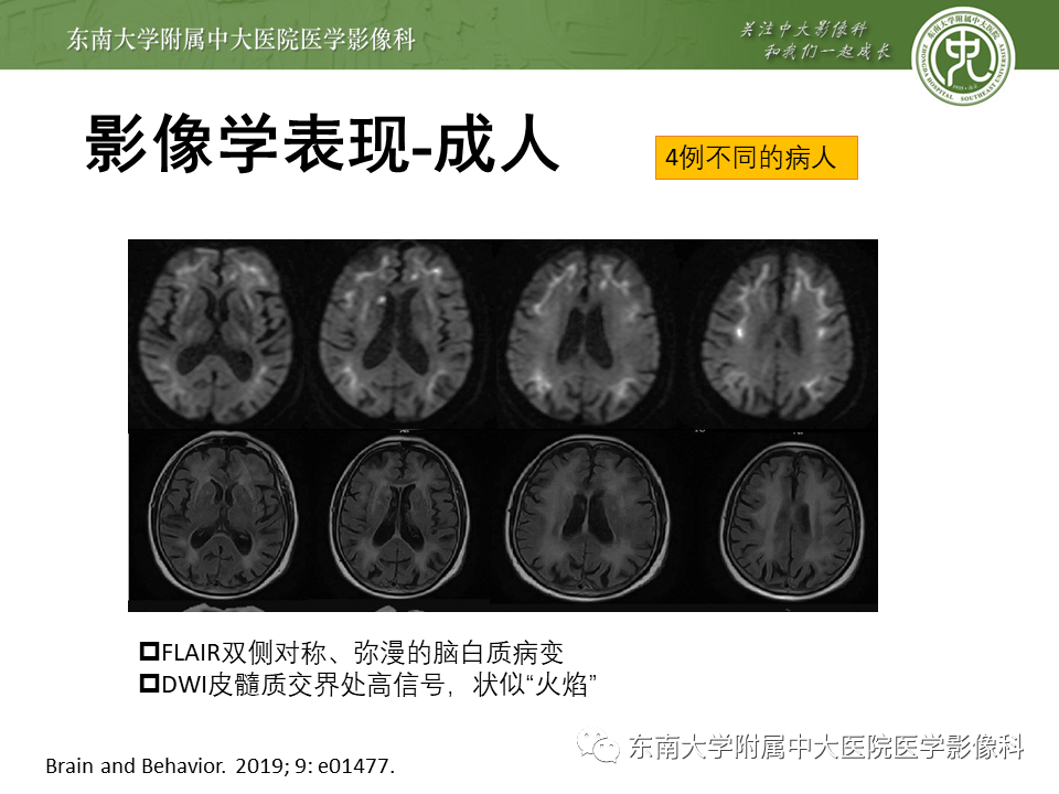 影像PPT - 【PPT】神经元核内包涵体病（NIID）的影像学诊断-18