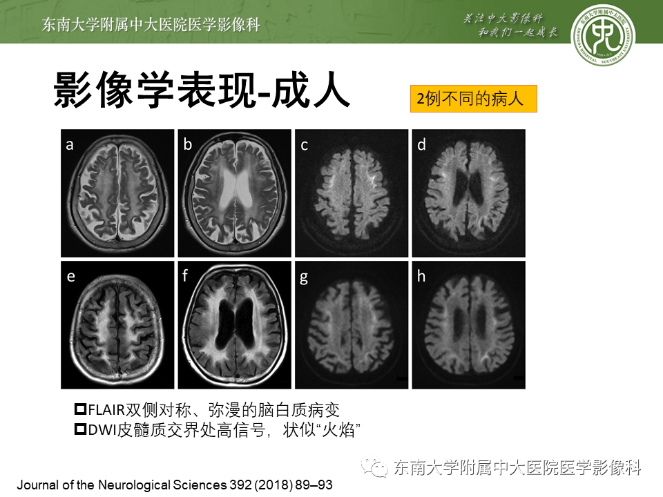 影像PPT - 【PPT】神经元核内包涵体病（NIID）的影像学诊断-19