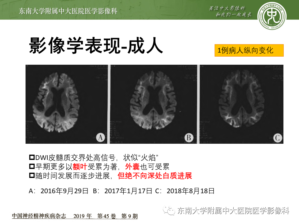 影像PPT - 【PPT】神经元核内包涵体病（NIID）的影像学诊断-20