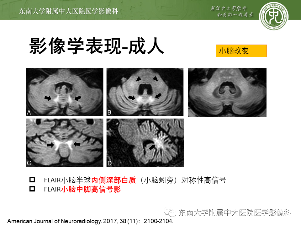 影像PPT - 【PPT】神经元核内包涵体病（NIID）的影像学诊断-21