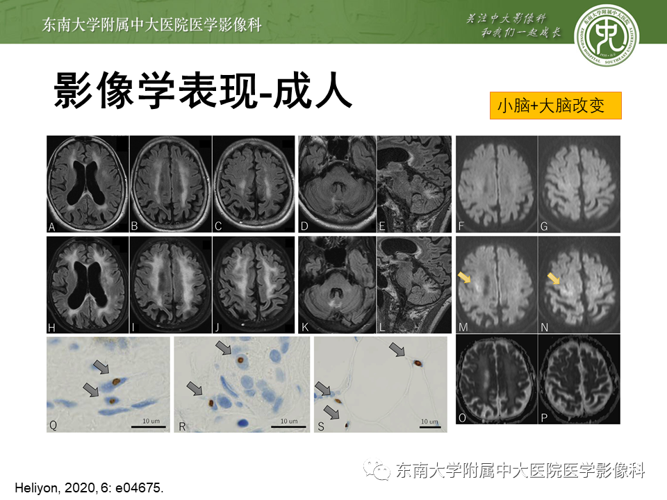 影像PPT - 【PPT】神经元核内包涵体病（NIID）的影像学诊断-23