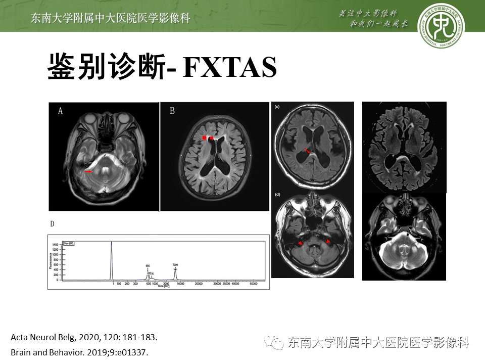 影像PPT - 【PPT】神经元核内包涵体病（NIID）的影像学诊断-26