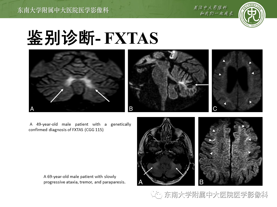 影像PPT - 【PPT】神经元核内包涵体病（NIID）的影像学诊断-27