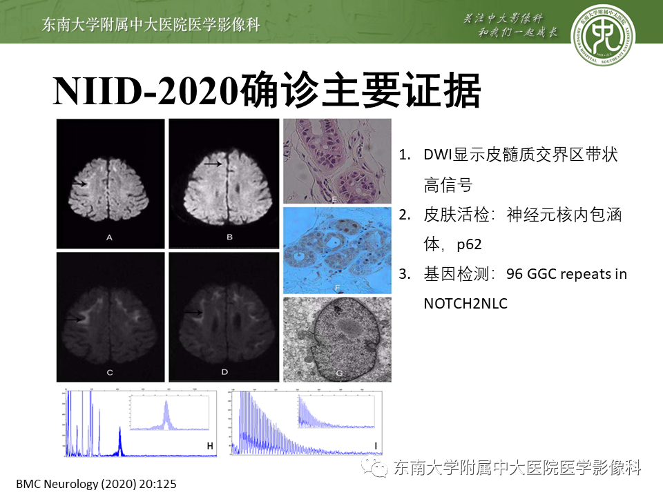 影像PPT - 【PPT】神经元核内包涵体病（NIID）的影像学诊断-29