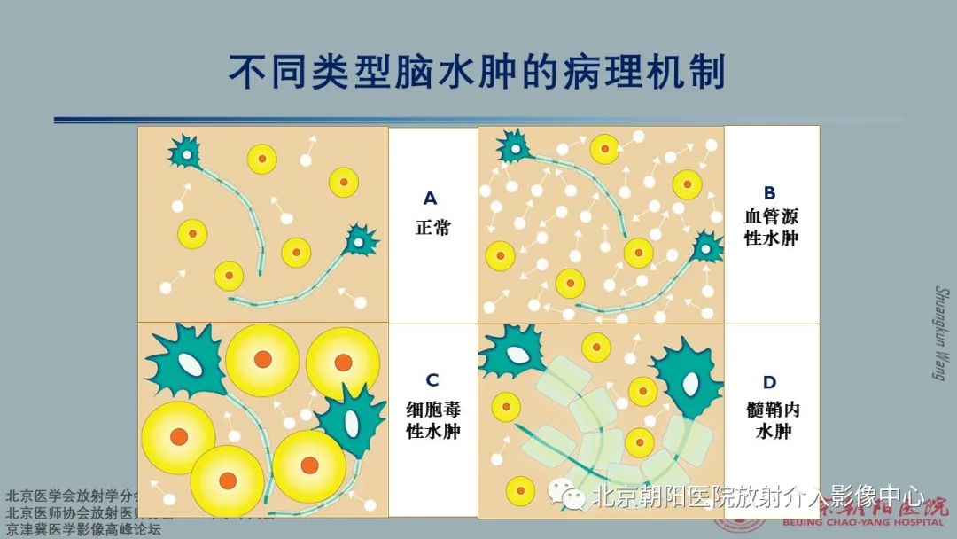 影像PPT - 【PPT】中毒性脑病（TEP）影像表现模式及特征-6