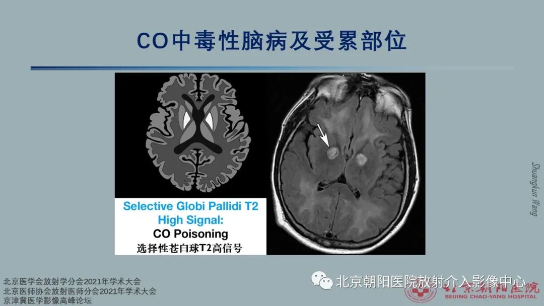 影像PPT - 【PPT】中毒性脑病（TEP）影像表现模式及特征-9