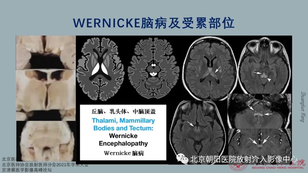 影像PPT - 【PPT】中毒性脑病（TEP）影像表现模式及特征-8