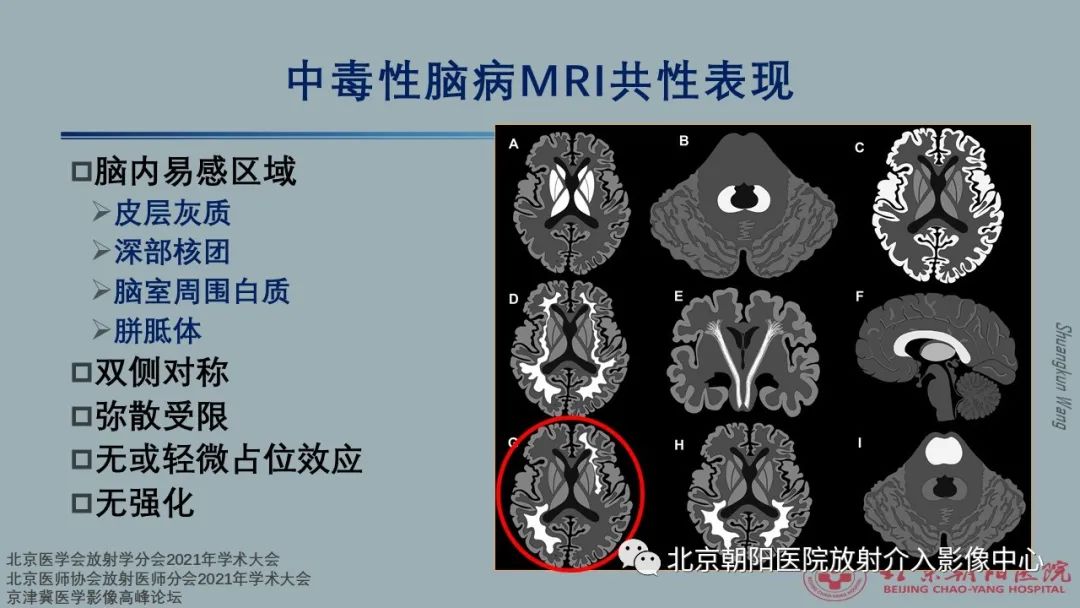 影像PPT - 【PPT】中毒性脑病（TEP）影像表现模式及特征-7