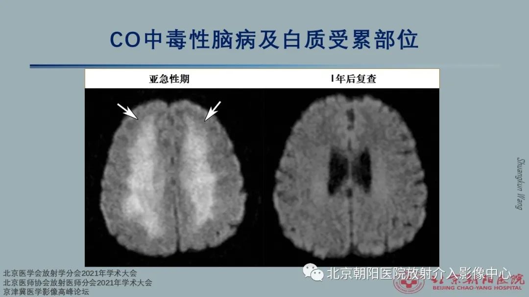 影像PPT - 【PPT】中毒性脑病（TEP）影像表现模式及特征-10