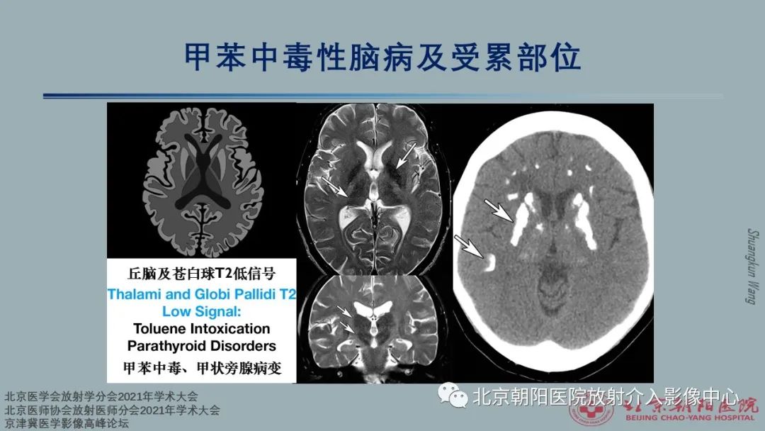 影像PPT - 【PPT】中毒性脑病（TEP）影像表现模式及特征-14