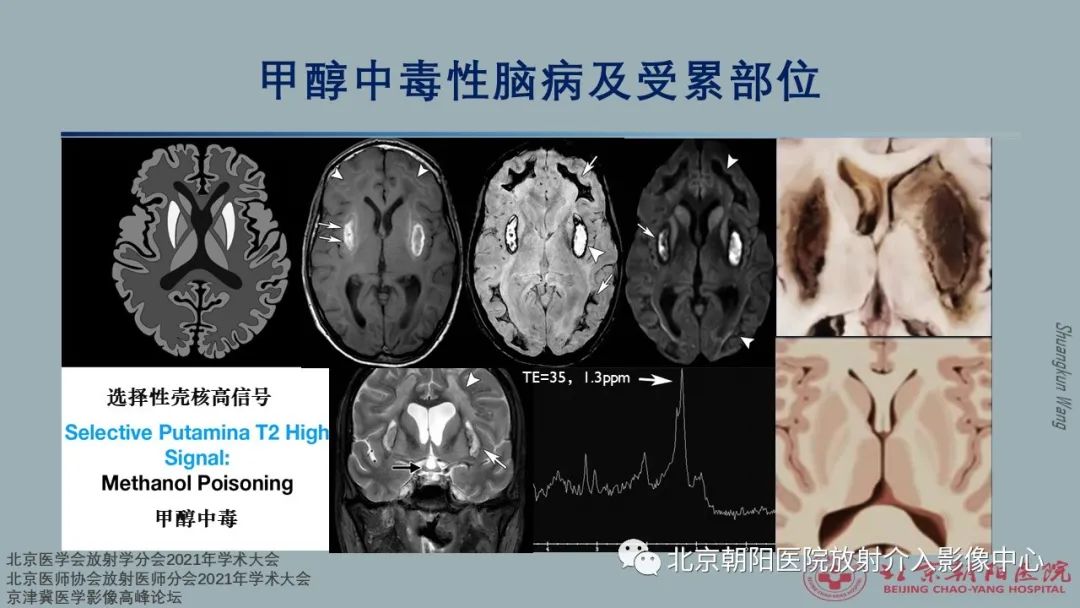 影像PPT - 【PPT】中毒性脑病（TEP）影像表现模式及特征-13