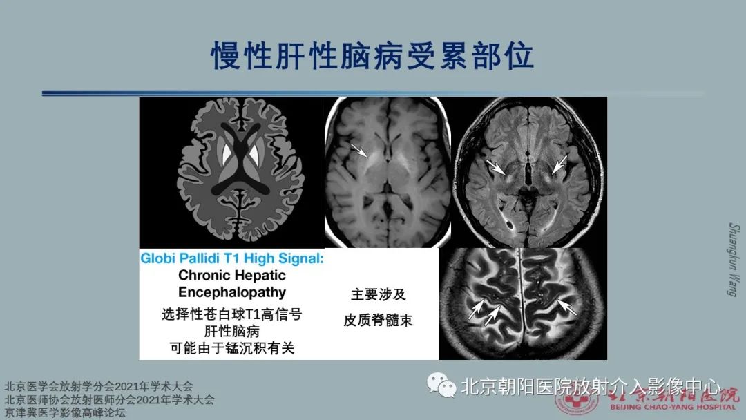 影像PPT - 【PPT】中毒性脑病（TEP）影像表现模式及特征-11