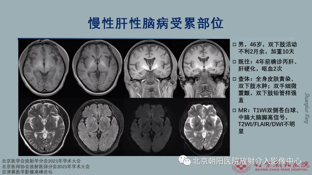 影像PPT - 【PPT】中毒性脑病（TEP）影像表现模式及特征-12