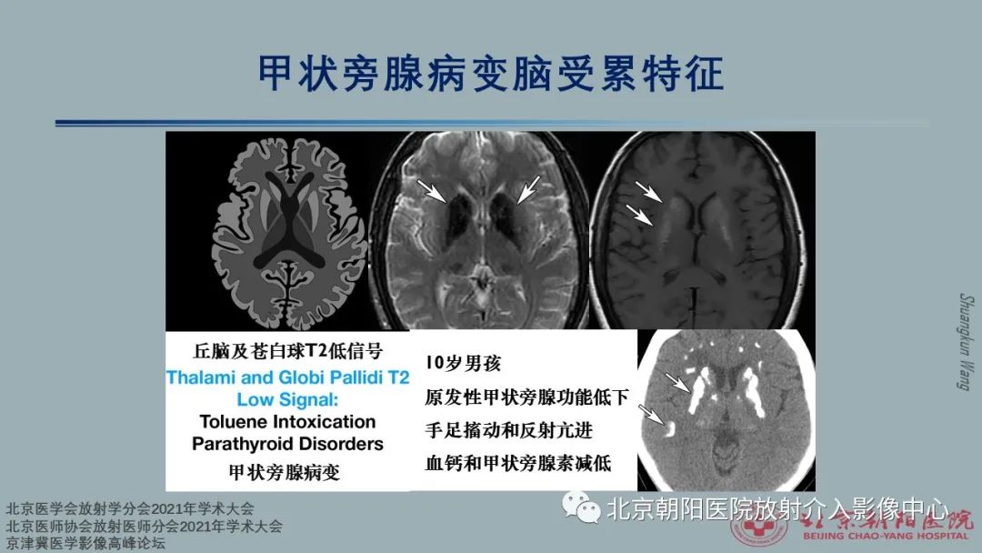 影像PPT - 【PPT】中毒性脑病（TEP）影像表现模式及特征-15