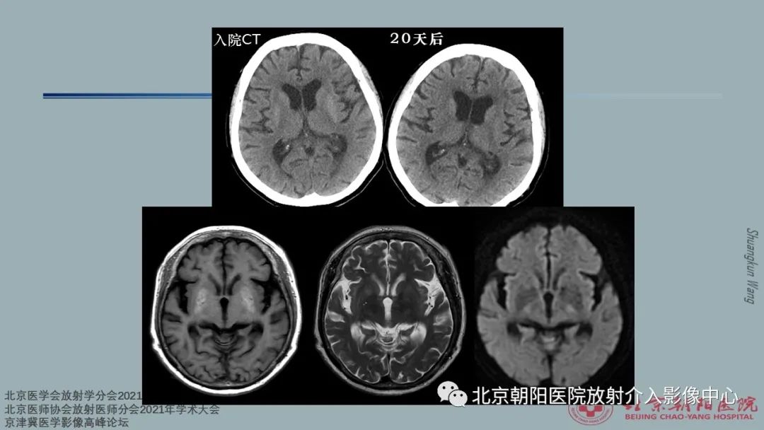 影像PPT - 【PPT】中毒性脑病（TEP）影像表现模式及特征-19